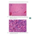 Стимуляция регенерации печени у больных циррозом. 2-е изд.